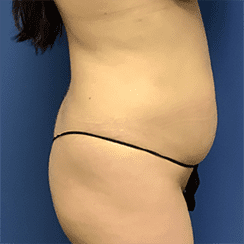 Tummy Tuck Before & After Patient #2539