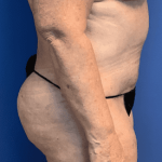 Tummy Tuck Before & After Patient #2544