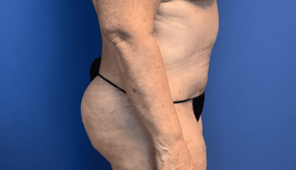 Tummy Tuck Before & After Patient #2544