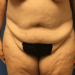 Tummy Tuck Before & After Patient #2544
