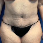 Tummy Tuck Before & After Patient #2544