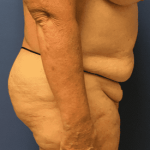 Tummy Tuck Before & After Patient #2544