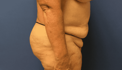 Tummy Tuck Before & After Patient #2544