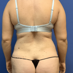 Tummy Tuck Before & After Patient #2549