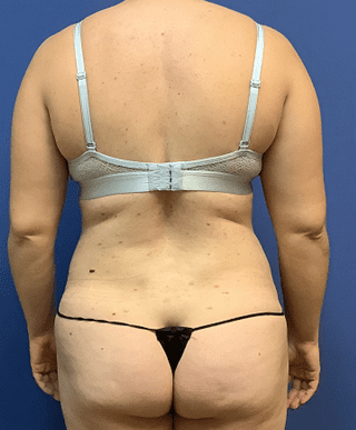 Tummy Tuck Before & After Patient #2549
