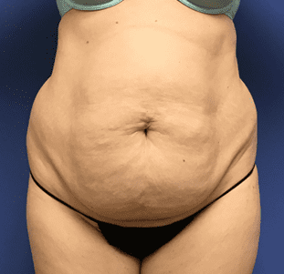 Tummy Tuck Before & After Patient #2549