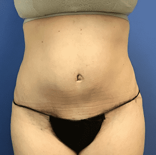 Tummy Tuck Before & After Patient #2549