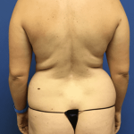 Tummy Tuck Before & After Patient #2549