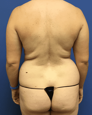 Tummy Tuck Before & After Patient #2549