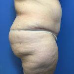 Tummy Tuck Before & After Patient #2554