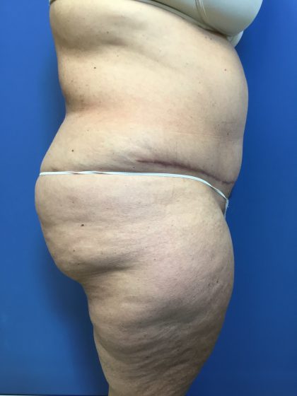 Tummy Tuck Before & After Patient #2554