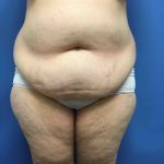 Tummy Tuck Before & After Patient #2554