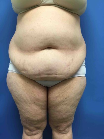 Tummy Tuck Before & After Patient #2554