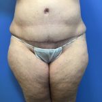 Tummy Tuck Before & After Patient #2554