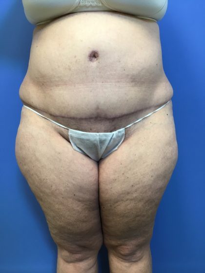 Tummy Tuck Before & After Patient #2554
