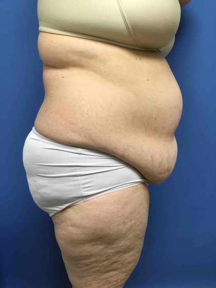 Tummy Tuck Before & After Patient #2554