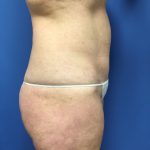 Tummy Tuck Before & After Patient #2559
