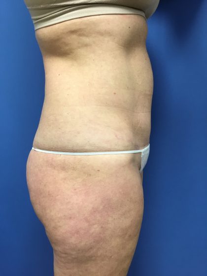 Tummy Tuck Before & After Patient #2559