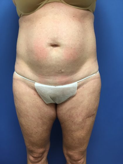 Tummy Tuck Before & After Patient #2559