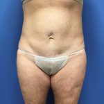 Tummy Tuck Before & After Patient #2559