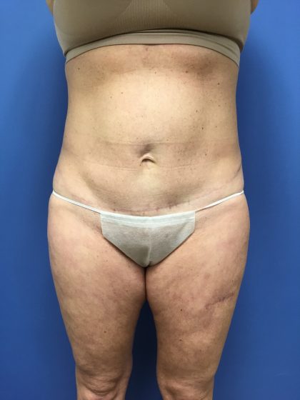 Tummy Tuck Before & After Patient #2559