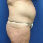 Tummy Tuck Before & After Patient #2559