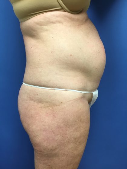 Tummy Tuck Before & After Patient #2559