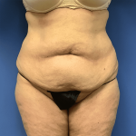 Tummy Tuck Before & After Patient #2564