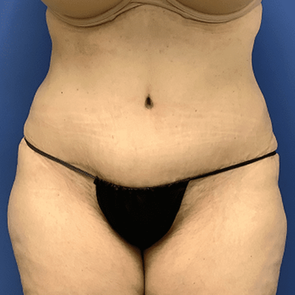 Tummy Tuck Before & After Patient #2564
