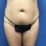 Tummy Tuck Before & After Patient #2574