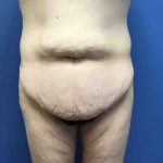 Tummy Tuck Before & After Patient #2579