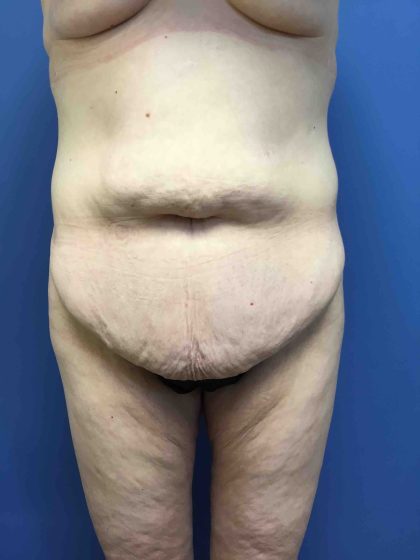 Tummy Tuck Before & After Patient #2579