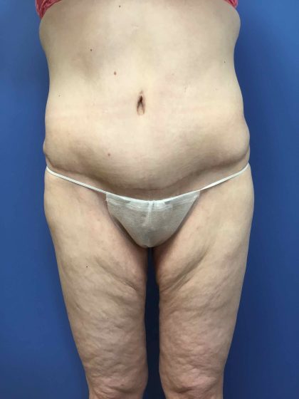 Tummy Tuck Before & After Patient #2579