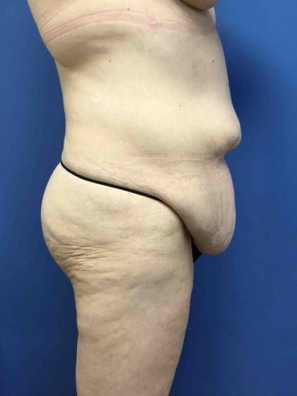 Tummy Tuck Before & After Patient #2579