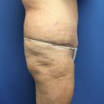 Tummy Tuck Before & After Patient #2584