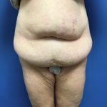 Tummy Tuck Before & After Patient #2584