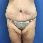 Tummy Tuck Before & After Patient #2584