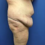 Tummy Tuck Before & After Patient #2584
