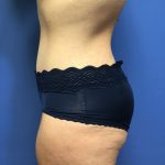 Tummy Tuck Before & After Patient #2589