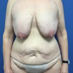 Tummy Tuck Before & After Patient #2594