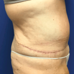 Tummy Tuck Before & After Patient #2599