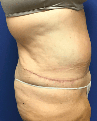 Tummy Tuck Before & After Patient #2599