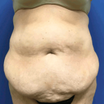 Tummy Tuck Before & After Patient #2599