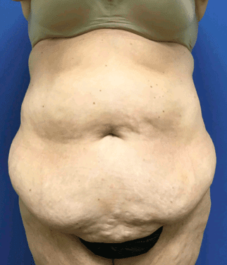 Tummy Tuck Before & After Patient #2599