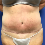 Tummy Tuck Before & After Patient #2599