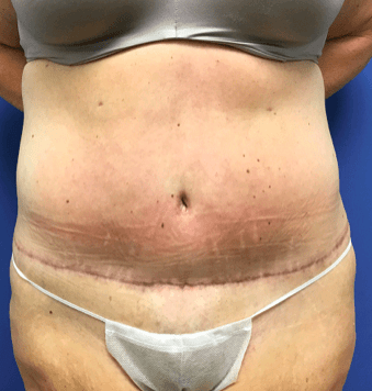 Tummy Tuck Before & After Patient #2599