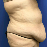 Tummy Tuck Before & After Patient #2599