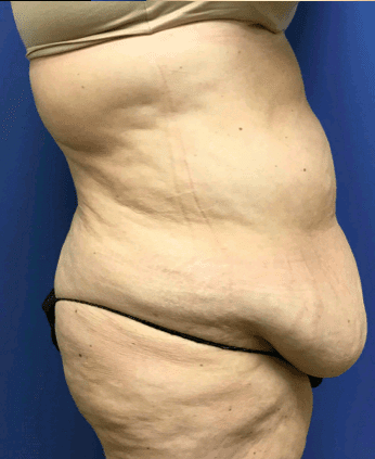 Tummy Tuck Before & After Patient #2599