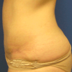 Tummy Tuck Before & After Patient #2604