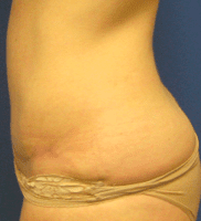 Tummy Tuck Before & After Patient #2604